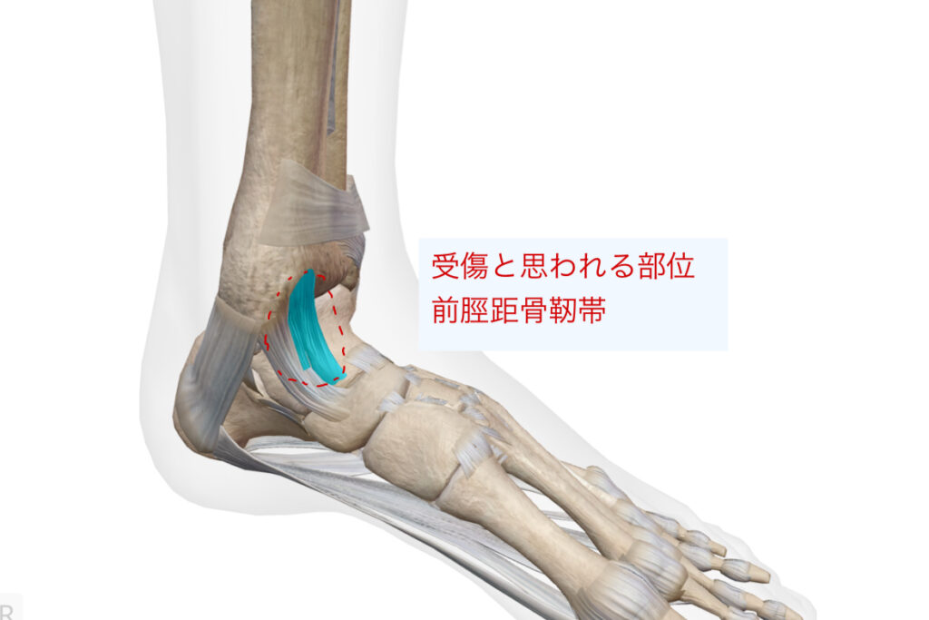三角靭帯捻挫症例3