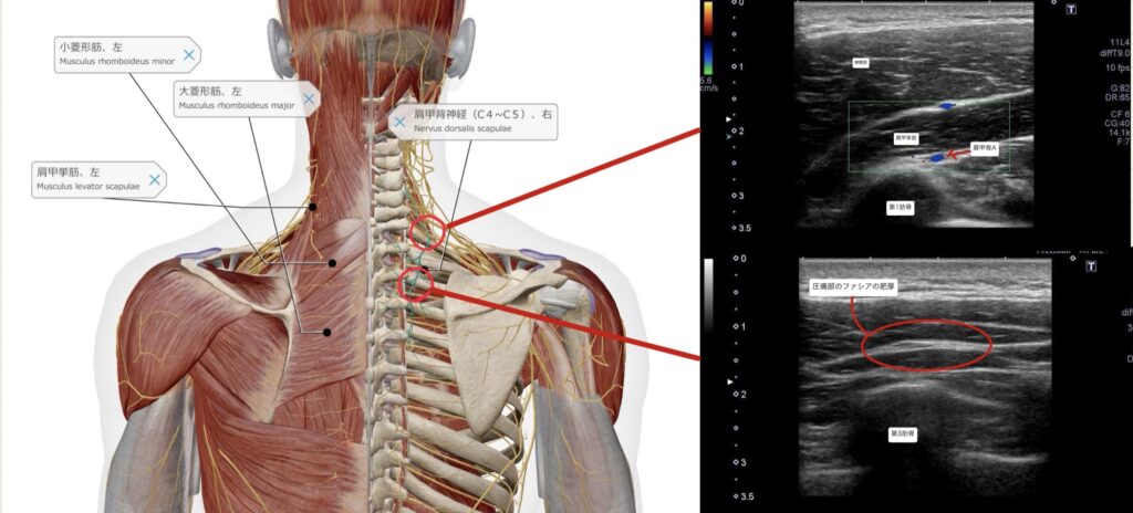 肩甲骨内側の痛み1