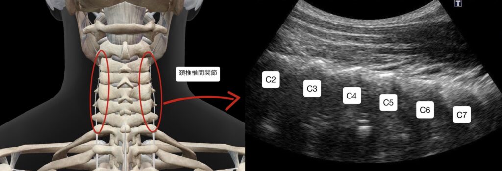 肩甲骨内側の痛み3