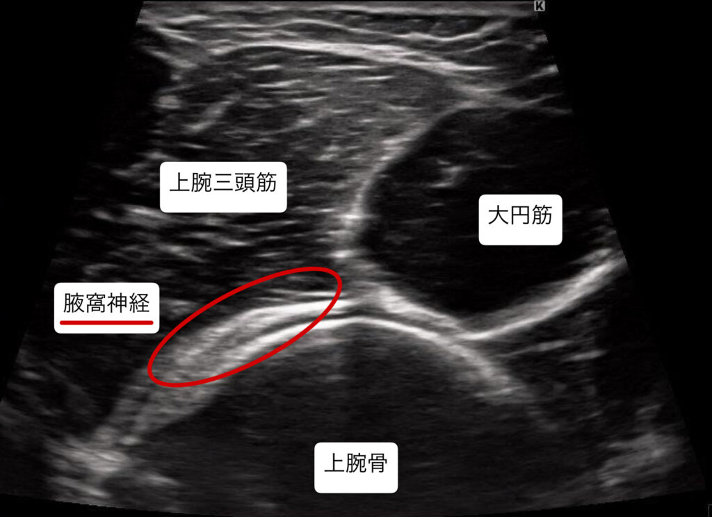 20代肩痛4