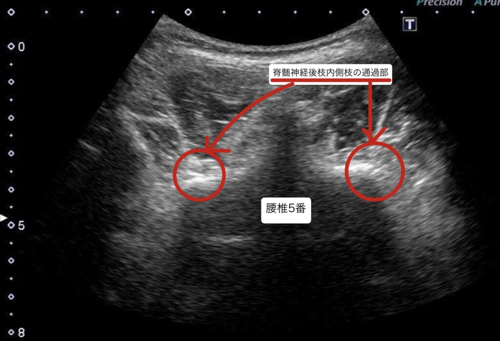 10代腰痛3