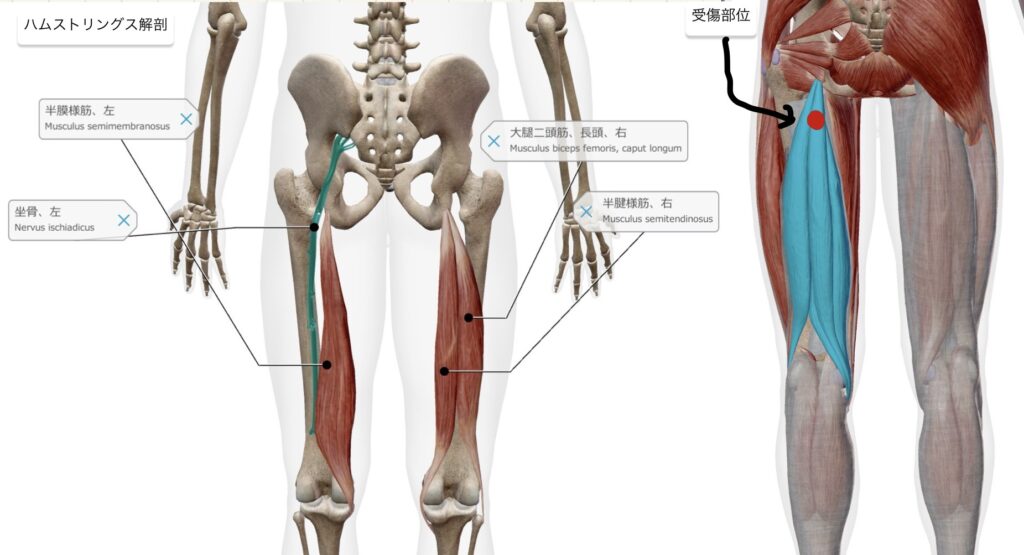 30Hammusclestrain1