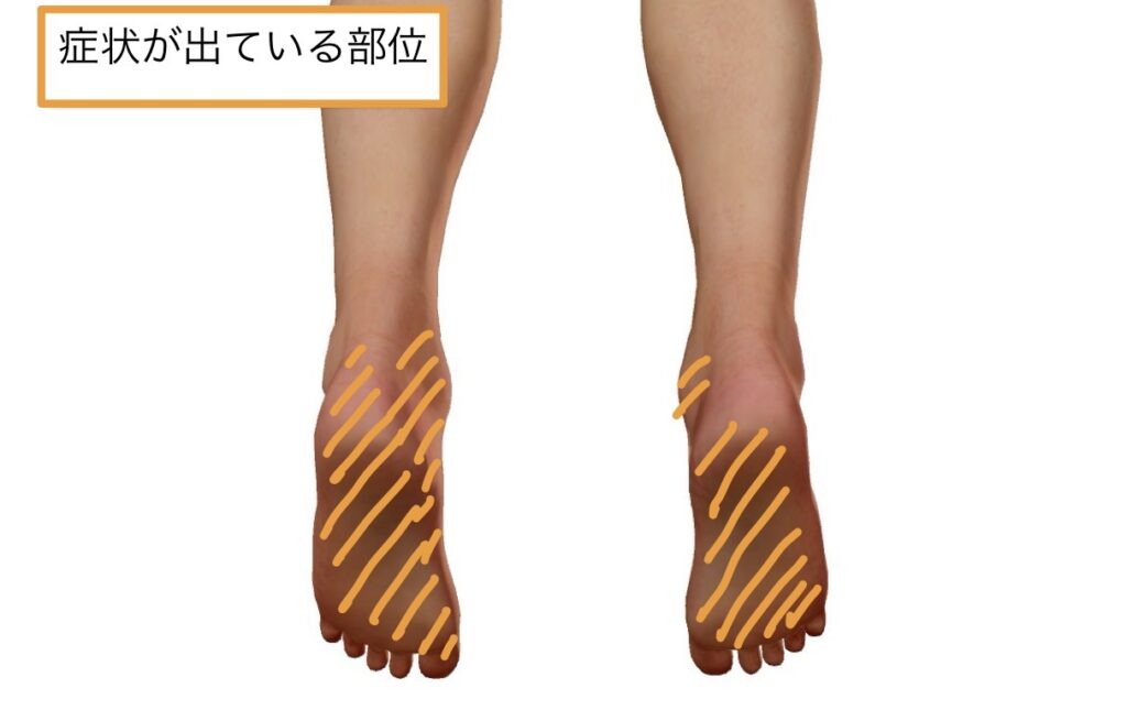 70soleofthefoot1