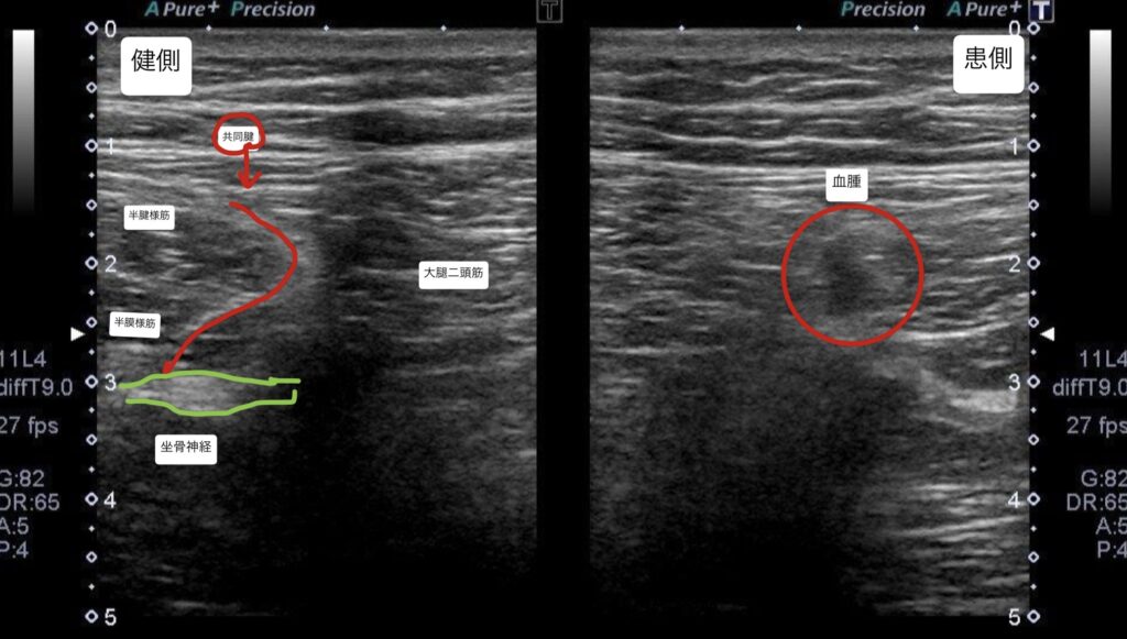 30Hammusclestrain2