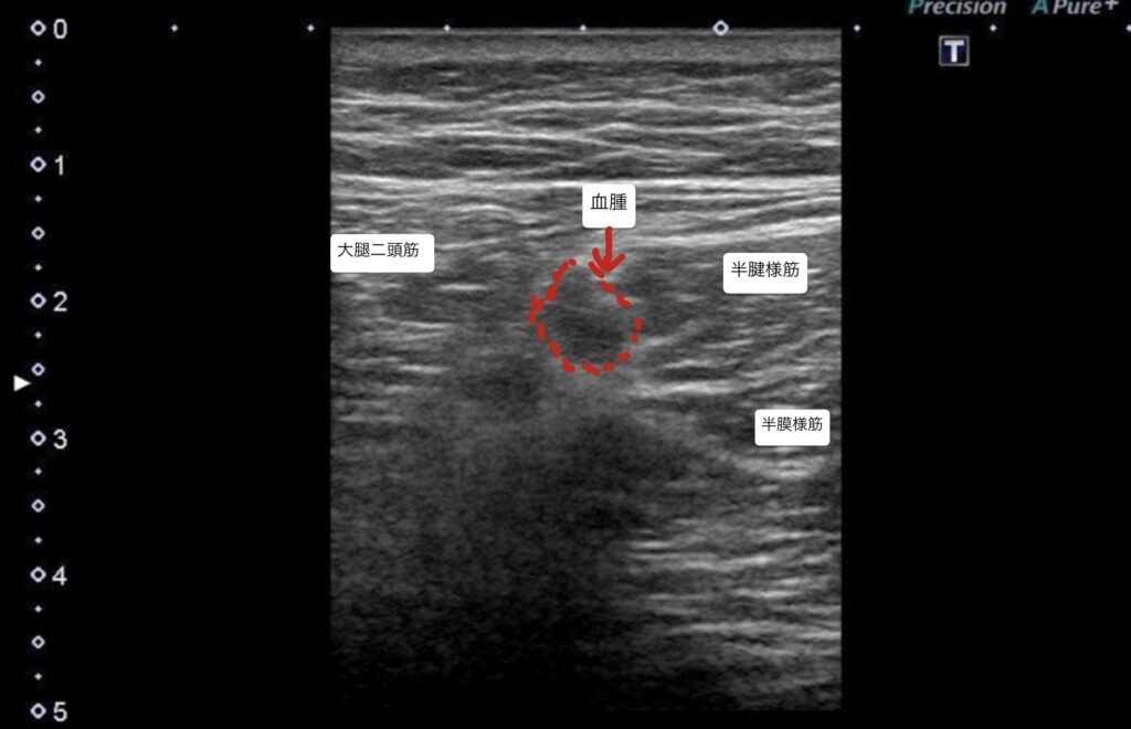 30Hammusclestrain3