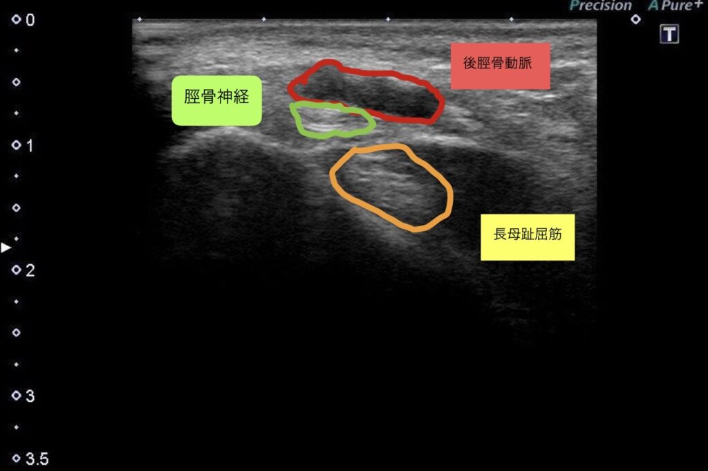 30代アキレス腱の痛み3