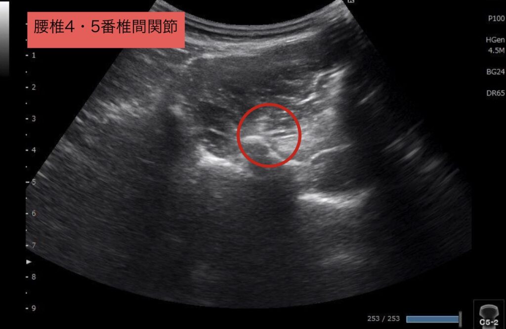 10代腰痛4